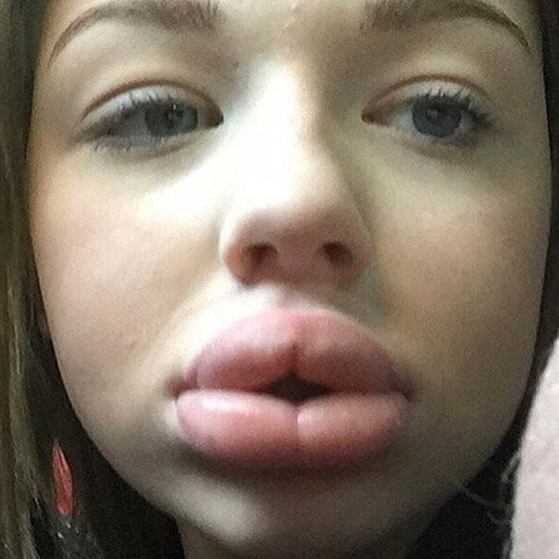 Kylie Jenner Lip Challenge Aftermath